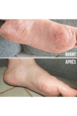 Chaussons de Soin - Pieds Fragilisés - MÊME